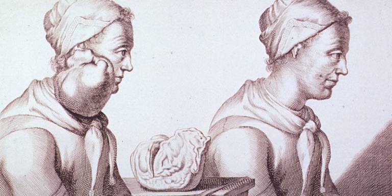 Two views of Clara Jacobi, a Dutch woman who had a tumor removed from her neck. Seventeenth-century cut