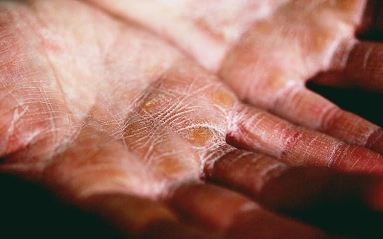 Palms of hands showing skin irritation from eczema