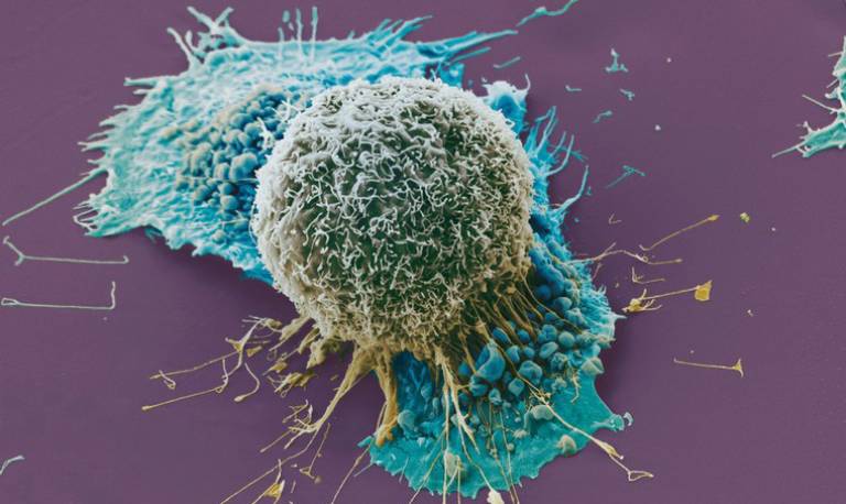 Lung cancer cells image from a scanning electron microscope