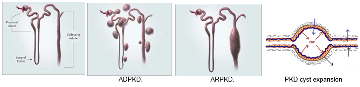 Four slides of polycystic kidney demonstration. Shows the collecting tubule in slide 1, followed by ADPKD in slide 2, ARPKD in slide 3, and a PKD cyst expansion in slide 4, with arrows showing the activity
