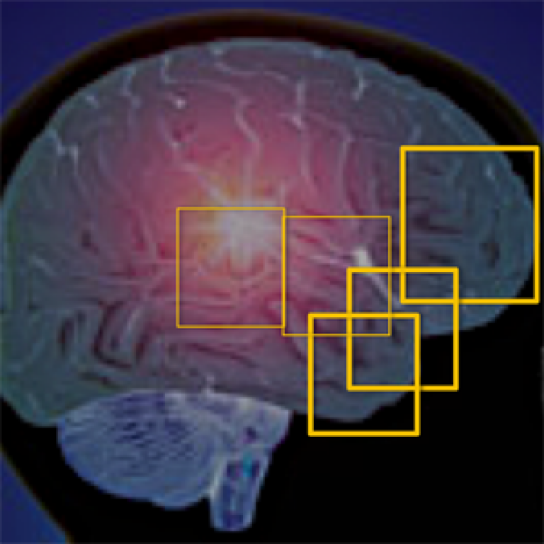 Frontotemporal Dementia map