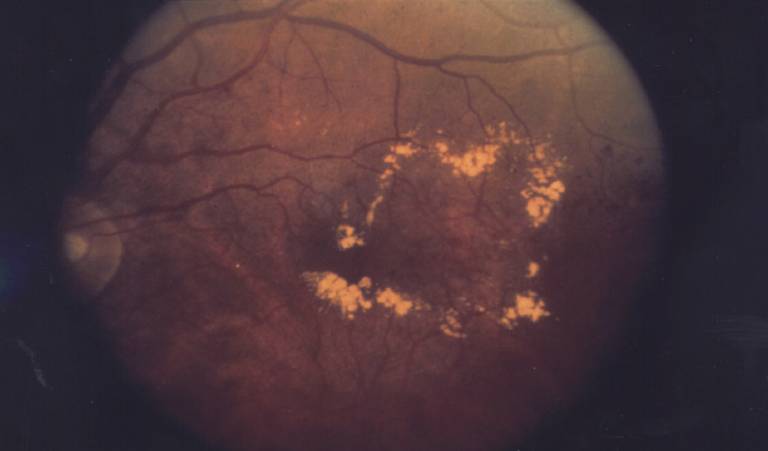 Diabetic macular oedema