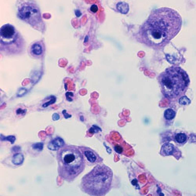 Cytomegalovirus