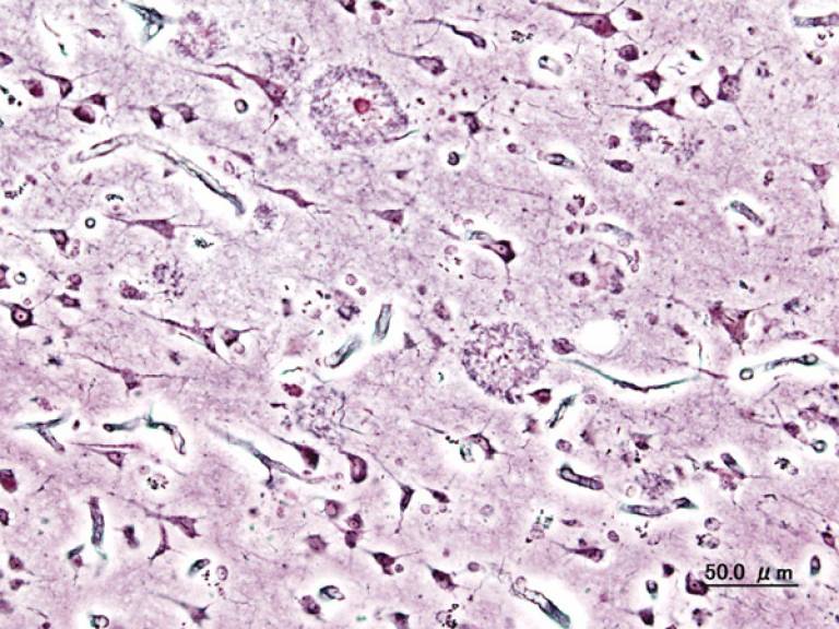Alzheimer's disease plaques