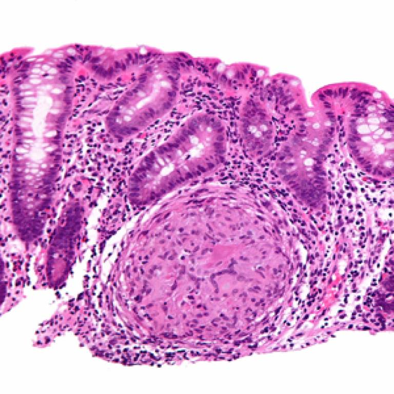 High magnification micrograph of Crohn's disease (Credit: Wikimedia commons/Nephron)