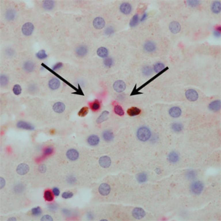 Magnified image of liver sample from Hepatitis B patient showing suppressor cells (brown) approaching T cells (red)