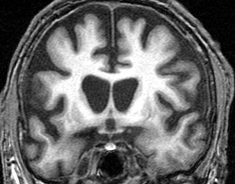 Brain affected by Huntington's disease