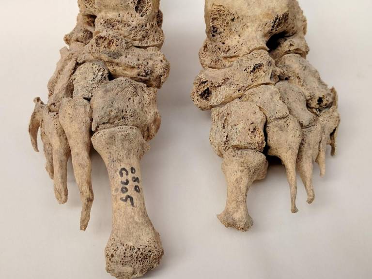 Skeletal remains showing evidence of leprosy