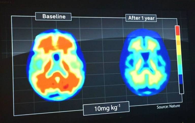 MRI scan showing brain changes in dementia