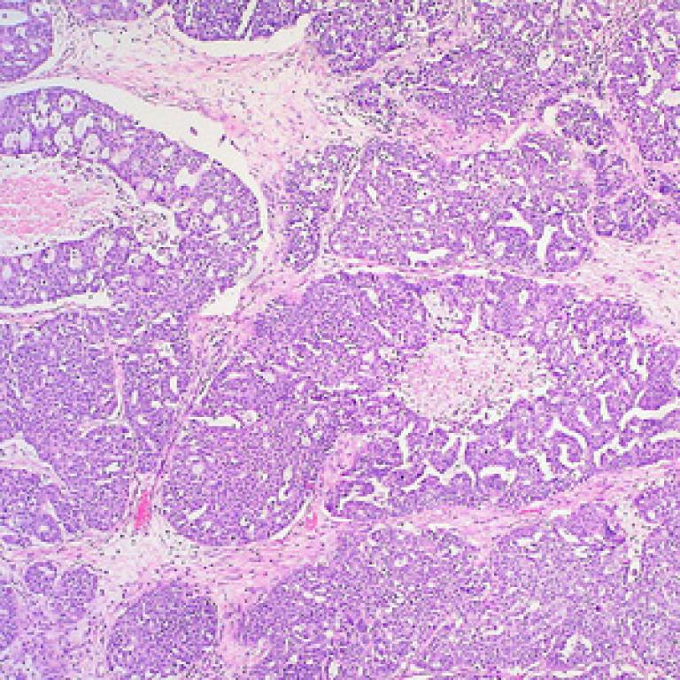 Ovarian cancer under the microscope