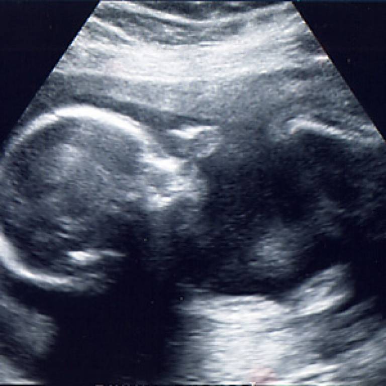 Ultrasound scan of foetus