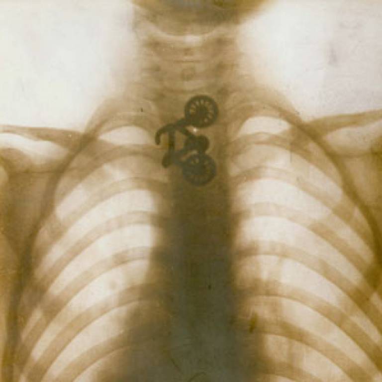 foreign bodies x ray