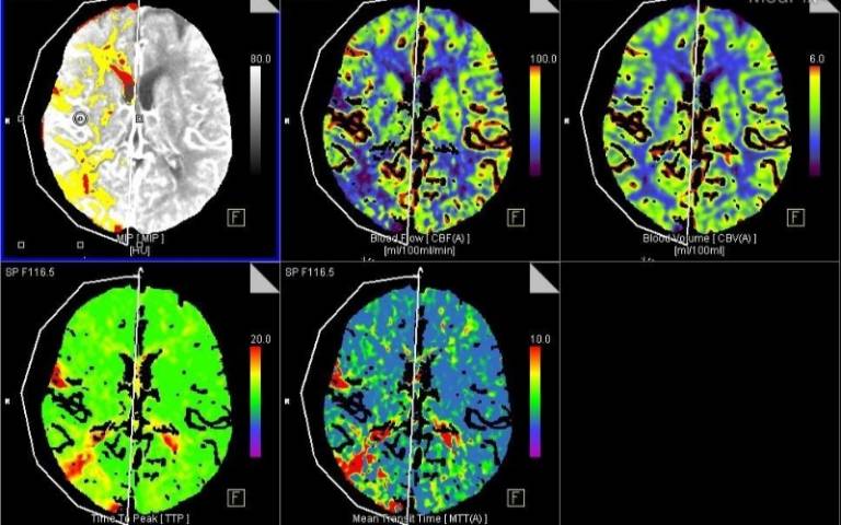 CT brain imaging of acute ischemic stroke