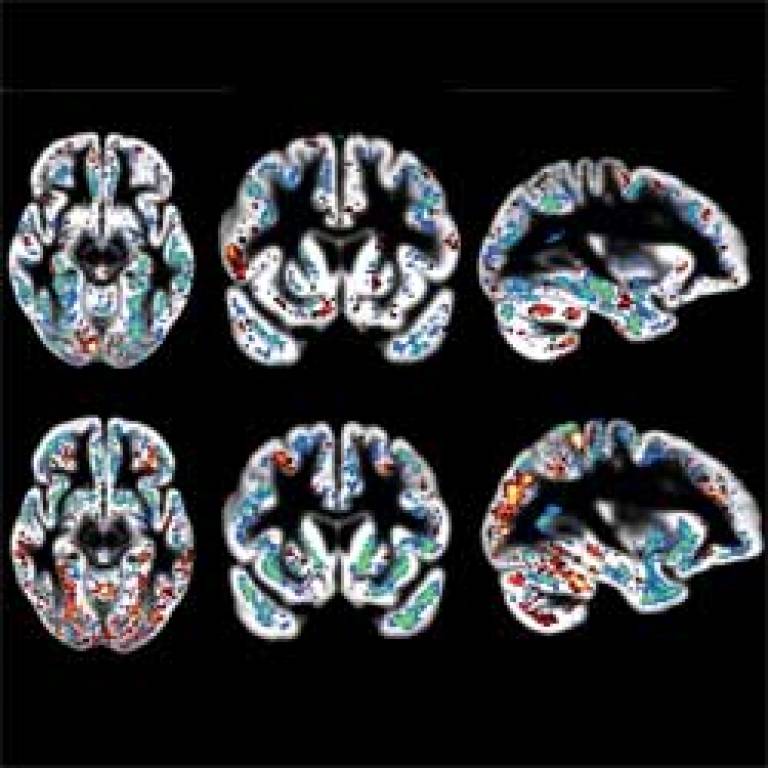 alzheimers brain scans