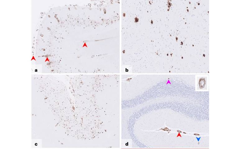 Amyloid deposits in brain