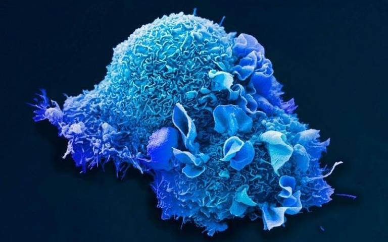 Lung cancer cell, credit: Anne Weston, EM STP