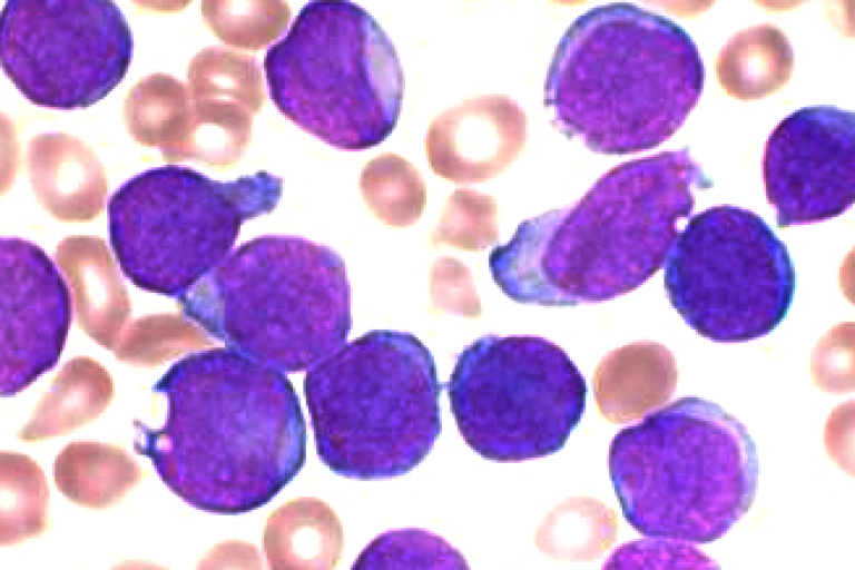 B cell leukaemia