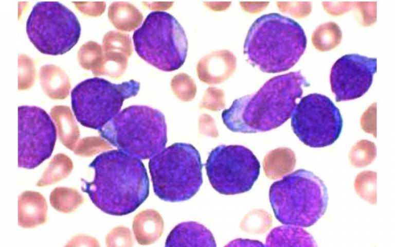 Stained bone marrow aspirate smear of patient with precursor B-cell acute lymphoblastic leukemia