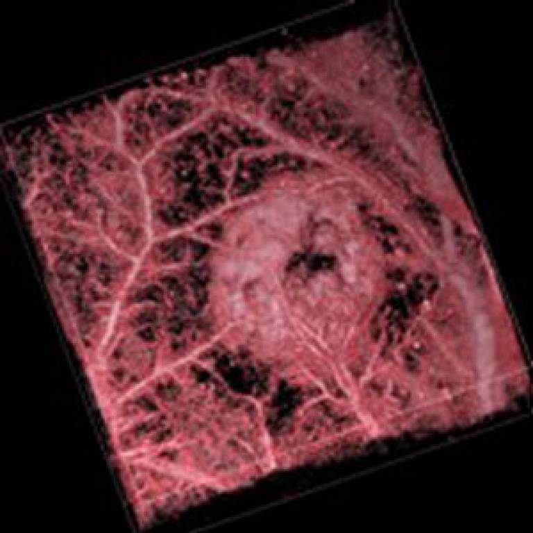 Photoacoustic image of a colorectal tumour