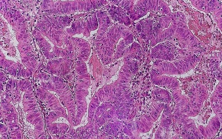 bowel cancer cells