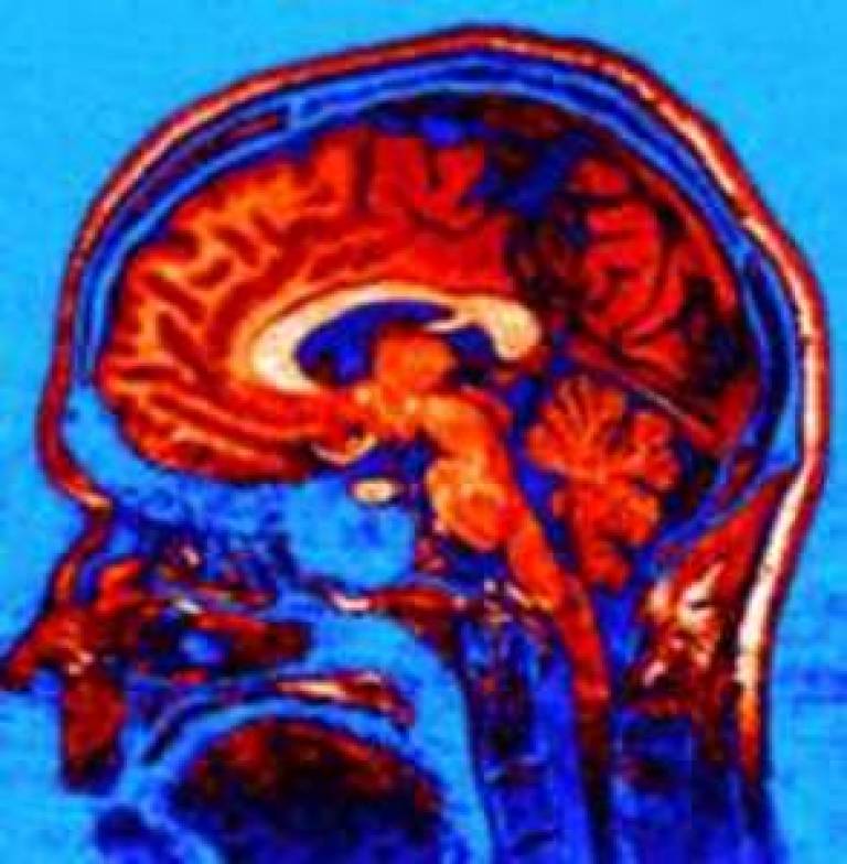 Brain scan using MRI