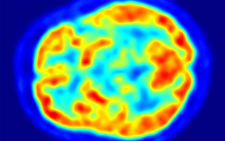 PET scan of the brain