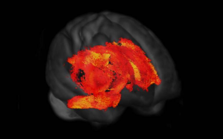 Brain wiring changes in Parkinson's