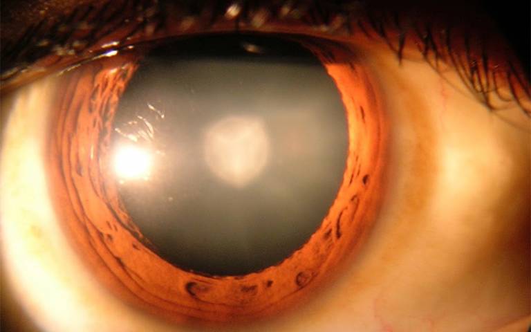Cataract in human eye