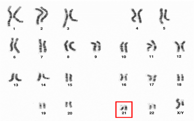 people with Down syndrome have an extra copy of chromosome 21
