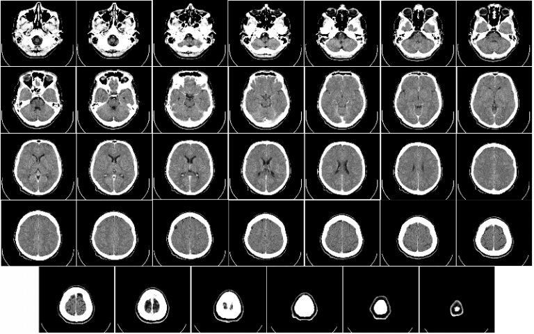 Computer tomography of human brain