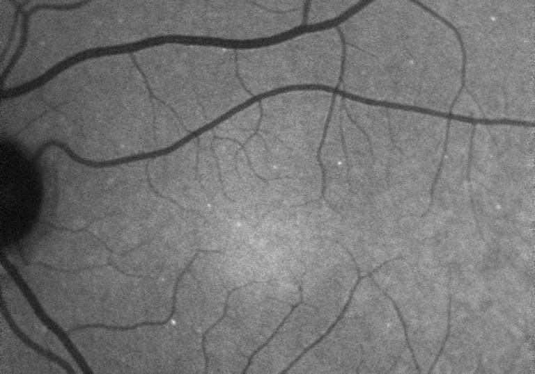 Image of retina shows hyperfluorescent signals - each white spot is a single “sick” retinal nerve cell - labelled in vivo using DARC technique