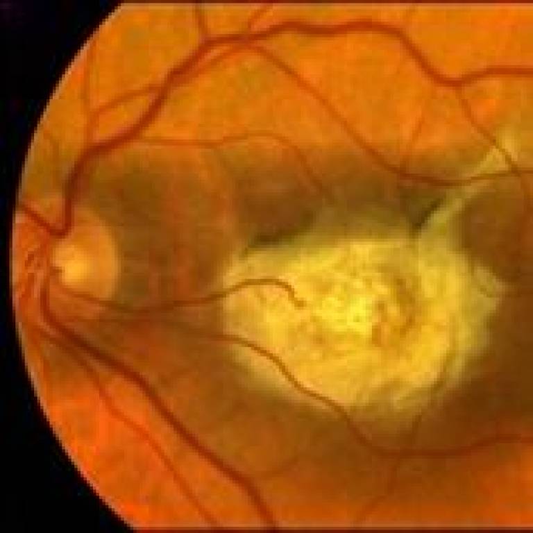 An eye affected by Age-Related Macular Degeneration