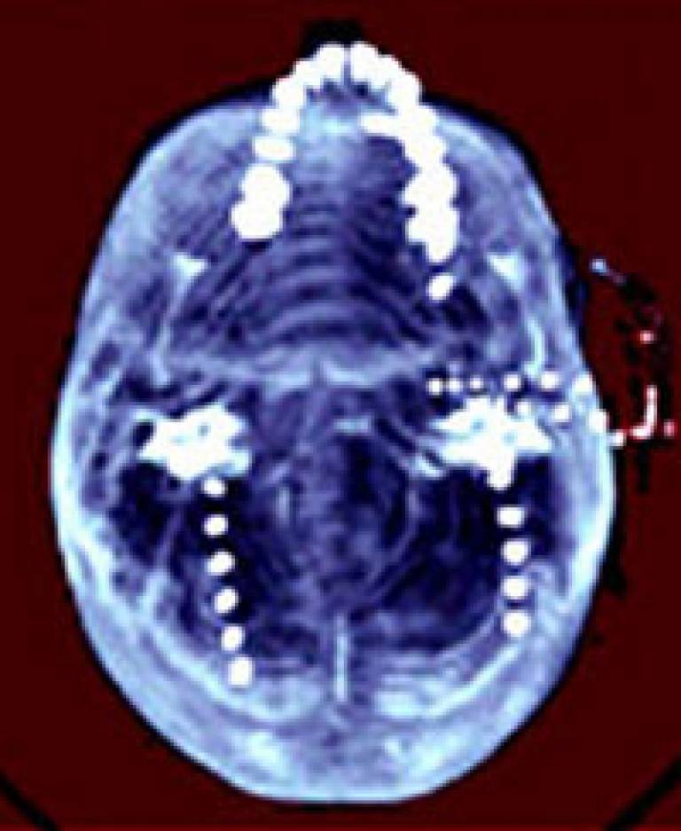 Scan of epilepsy sufferer's brain