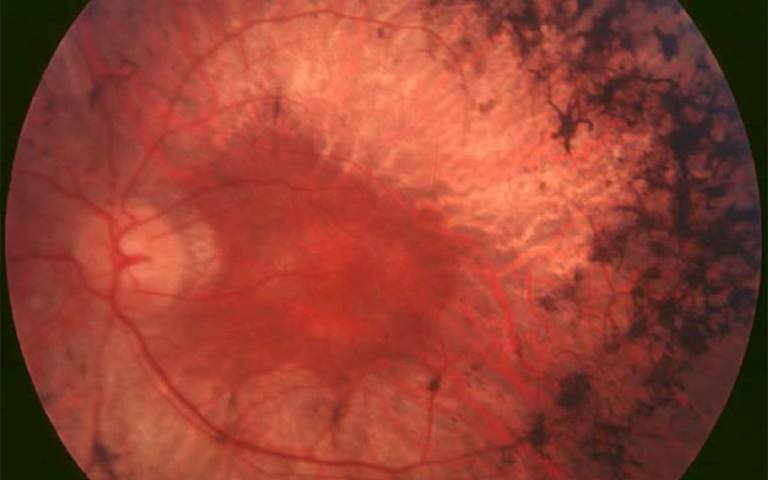 Eye with retinitis pigmentosa