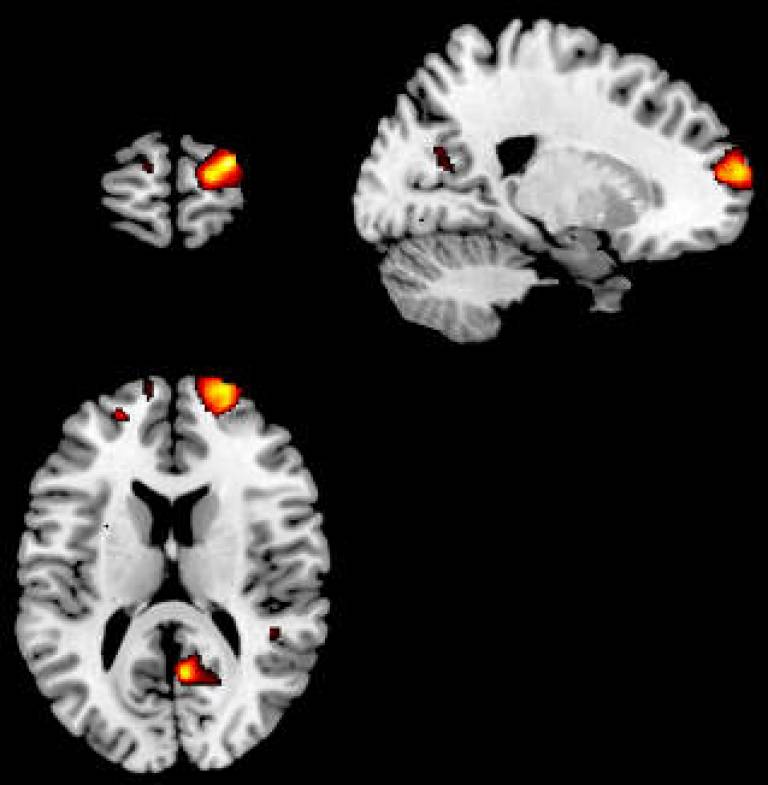 Views of inflated cortical surface showing areas of brain gray matter correlating with introspective accuracy.