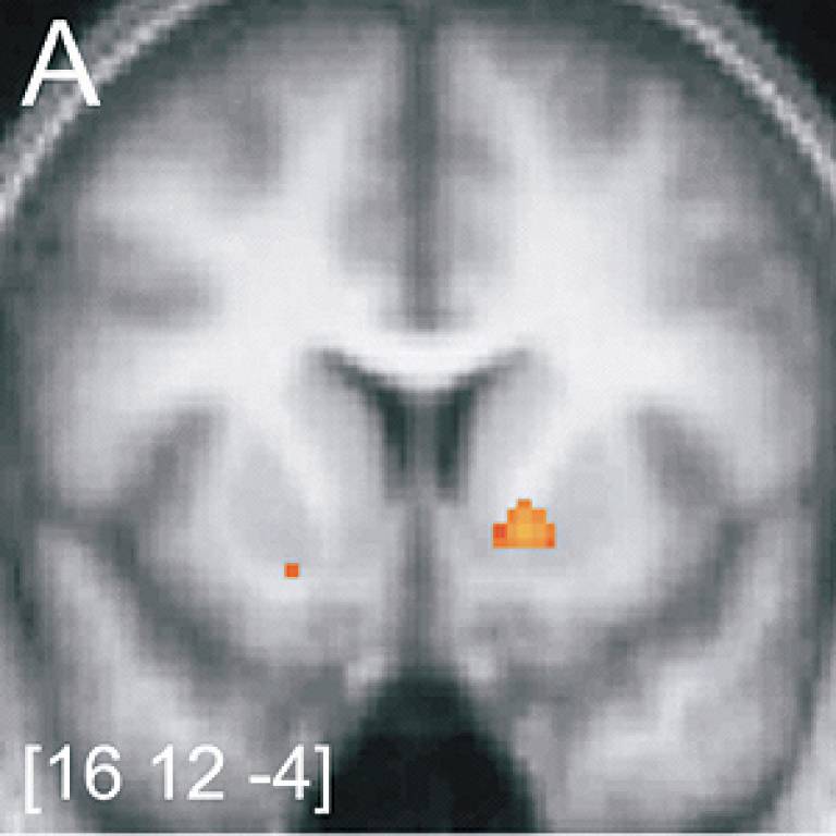 Funtional magnetic resonance image of ventral striatum activity