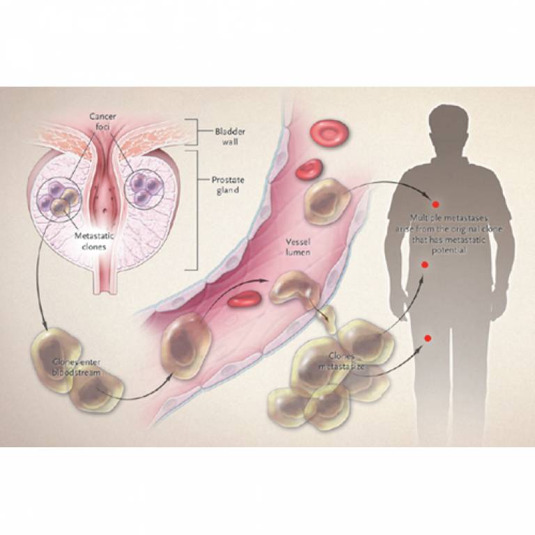 Origin of prostate cancer metastases