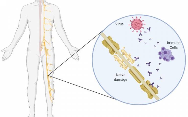 GBS is a rare but serious autoimmune condition that attacks the peripheral nervous system