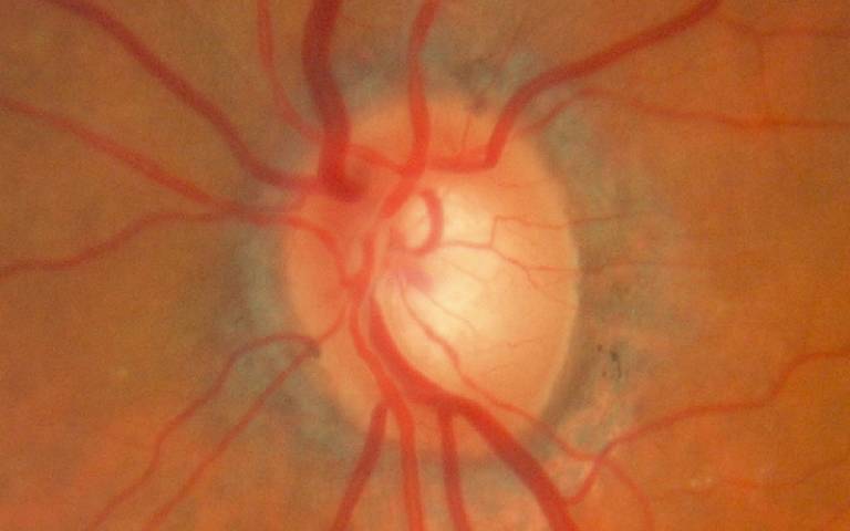 Optic nerve glaucoma
