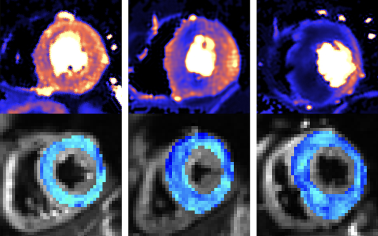 MRI images of the hearts of a healthy volunteer (left), individual with HCM gene but no symptoms (middle), patient with overt HCM (right).  Top: quantitative perfusion images showing defects in heart muscle blood flow (dark blue), bottom: cardiac diffusio