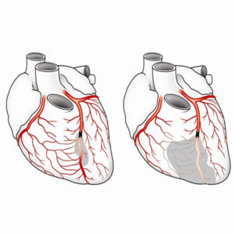 Illustration of coronary collaterals