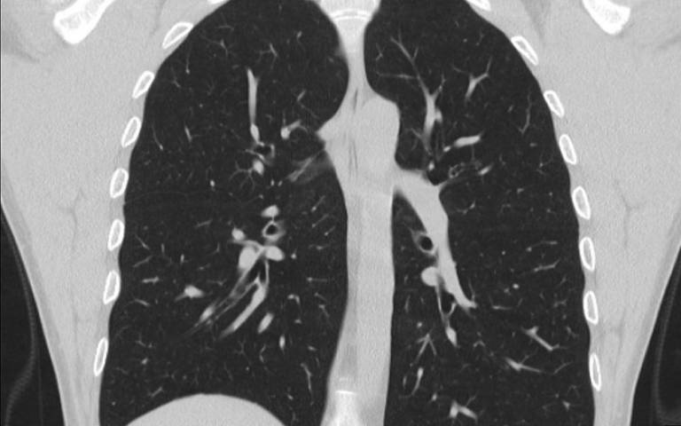 CT scan of healthy lung