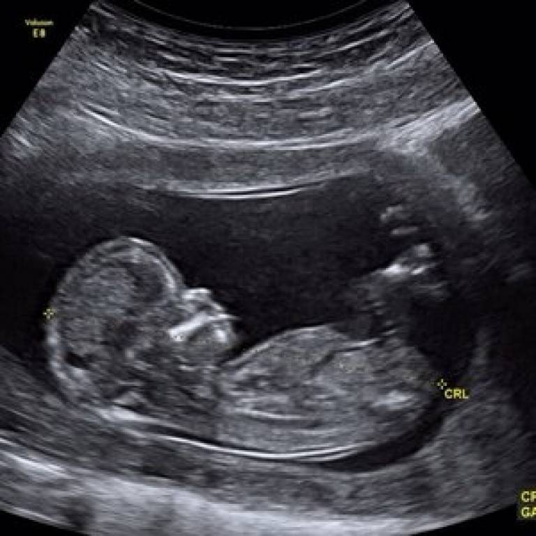 Ultrasound image of foetus