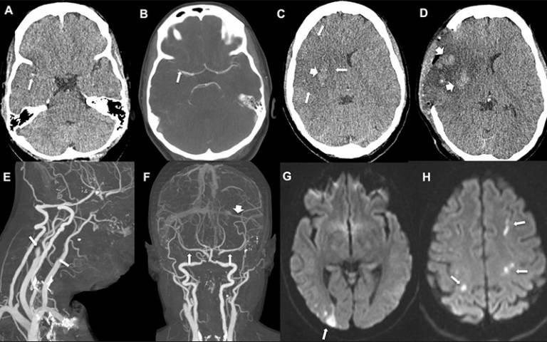 Brain scans of patients in case report