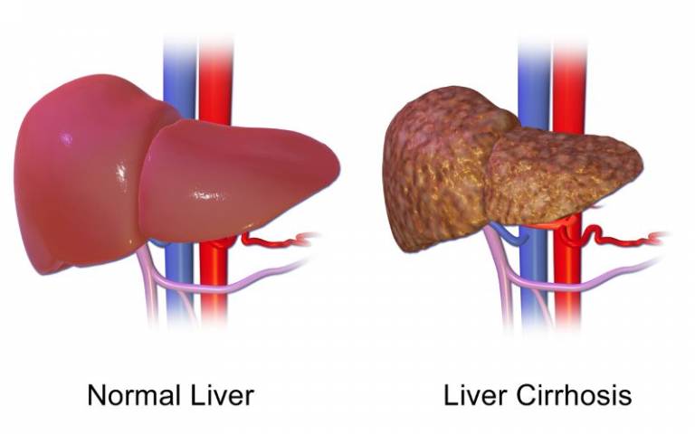 Liver disease is the fifth most common cause of death in the UK 