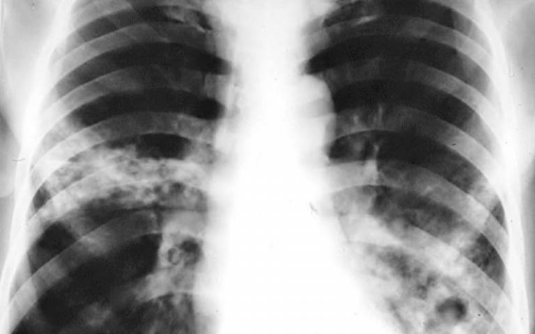Clouded areas in X-ray of lungs depict pneumonia infection