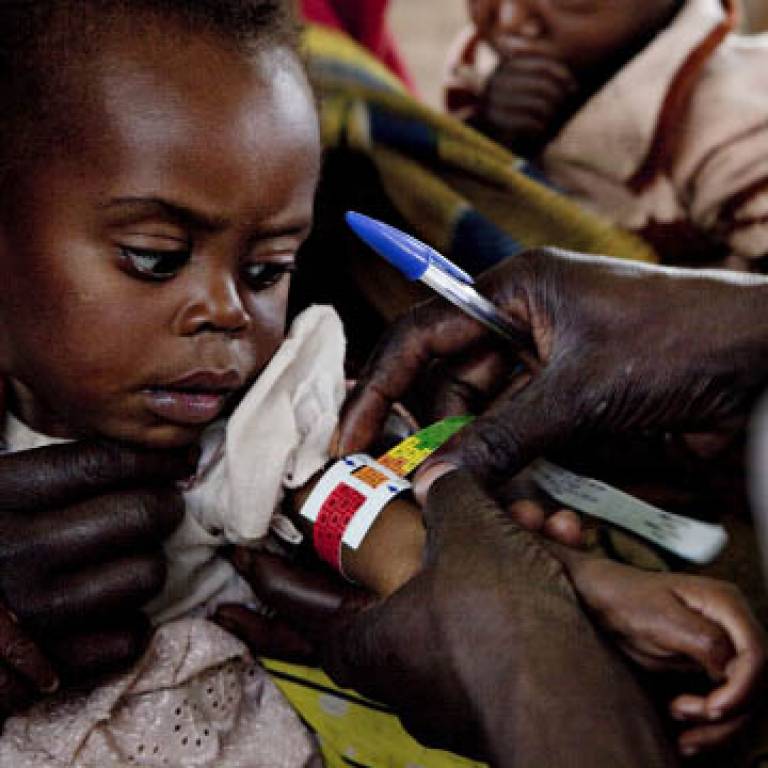 'The malnutrition that shouldn't be', Franco Pagetti/MSF