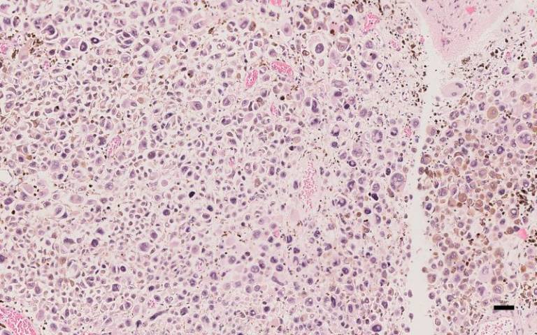 •	‘Image from the PEACE study demonstrating the atypical, discohesive, plasmacytoid cells characteristic of metastatic melanoma’