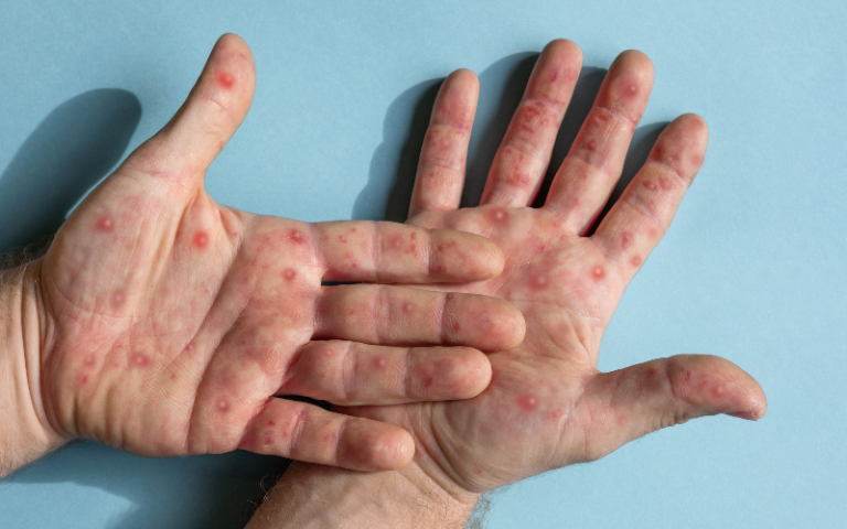 Male hands with Monkeypox rash