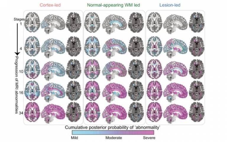 New MS subtypes defined as ‘cortex-led’, ‘normal-appearing white matter-led’, and ‘lesion-led
